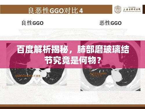 百度解析揭秘，肺部磨玻璃結節(jié)究竟是何物？